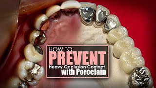 How To Prevent Heavy Occlusion Contact with Porcelain