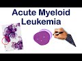 Acute Myeloid Leukemia (ALL) Mnemonic| USMLE Step NCLEX COMLEX