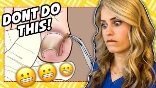 Foot doctor reacts: Ingrown nail gone wrong
