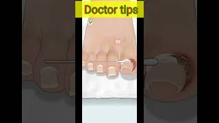 #shorts #foot# Ingrown Toenailand ear and earcleaning and earwax and Tonsil stone and treatment ||