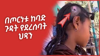 victims of Tigray war from kobo Ethiopia || በትግራይ ጦርነት ጉዳት የደረሰባቸው የቆቦ ከተማ ነዋሪዎች