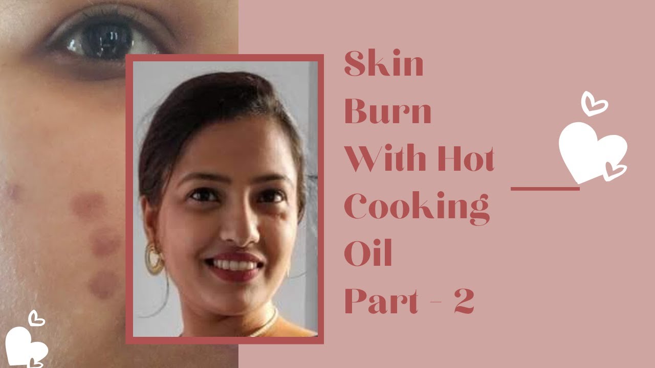 BURN TREATMENT - HOW TO Remove Your Burn Marks From Skin #2| Step By ...