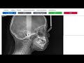 WebCeph: A.I.(artificial intelligence) Cephalometric Analysis platform for Orthodontic Diagnosis