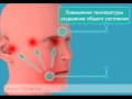 Периостит флюс. Лечение периостита. Периостит челюсти