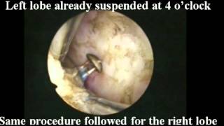 BPEP Bipolar Prostate Enucleation Procedure