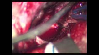 Interhemispheric transcallosal approach for resection of intraventricular central neurocytoma