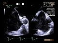 How to echocardiographically guide a trans-septal puncture - PITLOC Protocol