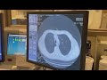 SSM Health Medical Minute: October is Lung Cancer Awareness Month