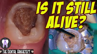 AMAZING Save of A Tooth w/ A Very BIG and DEEP Cavity #4k #C28