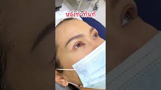 ใครมีปัญหาแบบนี้ ดูให้จบนะ #inzclinic #inZeye #ศัลยกรรม #ศัลยกรรมตา #จักษุแพทย์ #ตาสองชั้น