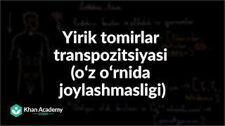 Yirik tomirlar transpozitsiyasi (oʻz oʻrnida joylashmasligi) | Siyanotik yurak kasalliklari