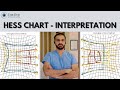 Hess Chart - Interpretation