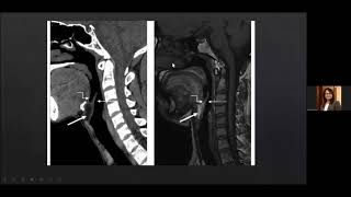 Radiological anatomy of Larynx and Hypopharynx- Dr Kajari Bhattacharya