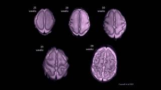 #3 James Boardman: Growing  up  following  premature  birth