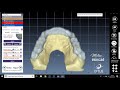 Placa miorrelaxante + Articulador Virtual | Alexandre Matias Dental Designer  | Exocad