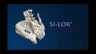 Globus Medical :SI LOK® Sacroiliac Joint Fixation System