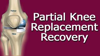 Partial Knee Replacement Recovery