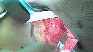 Transaxillary First Rib Resection - Dr. Julie Freischlag