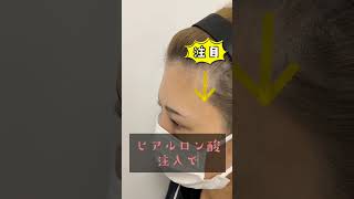 【額こめかみヒアルロン酸注入】術前→注入直後