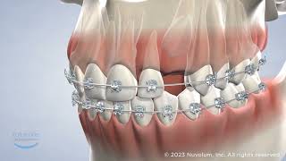 Guided Eruption at Full Smile Orthodontics