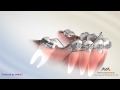 Orthodontic Treatment for Molar Uprighting - Cantilever Spring