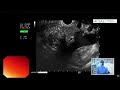 EUS of pancreas and surrounding structures (transgastric)