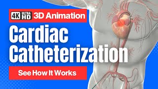 Cardiac Catheterization - See How It Works - 4K 3D Animation
