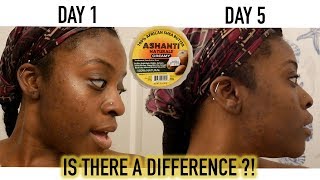 I USED RAW SHEA BUTTER ON MY FACE FOR 5 DAYS AND THESE ARE THE RESULTS....
