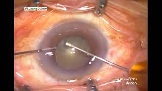 Cataract surgery 2019, with 10 year-old Infiniti system, old and good.