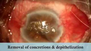 Calcacerous Degeneration under Topical Anesthesia