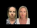 Non surgical treatment - facial filler before and after at The Sharp Clinic