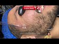 blackhead extractions blackhead and whitehead removal blackhead news this week blackhead news