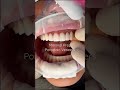 #veneers procedure #poponveneers #drtejaspatel Austin. TX #cosmeticdentist #shorts