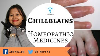 सर्दियों में ठंडे हाथ पाँव के लिए होमियोपैथी का बेस्ट इलाज || Homeopathy For CHILLBLAINS FROSTBITE