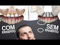 DENTES FIXOS:  Com Enxerto Ósseo OU Sem Enxerto Ósseo (Técnica All on 4)?