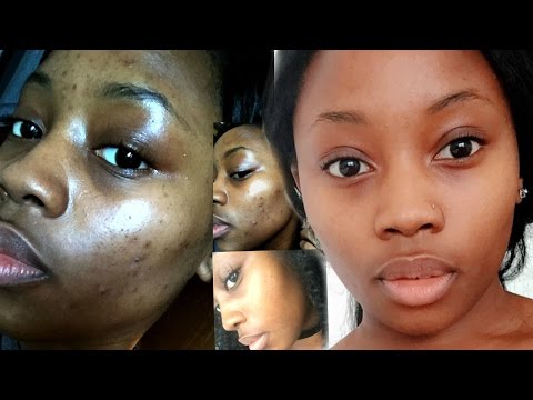 HOW TO: CLEAR ACNE IN 2 WEEKS ON A BUDGET! ALL NATURAL PRODUCTS HOW TO: CLEAR ACNE IN 2 WEEKS ON A BUDGET! ALL NATURAL PRODUCTS