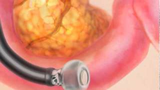 Endoscopic Ultrasound