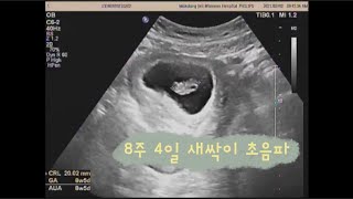 새싹이 임신기록 #3 / 임신초기 / 임신8주/ 8주4일 초음파영상 (태몽이야기, 젤리곰 ) _ 💙오!뉴월드💙 Oh! new World