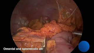 Managing an ischemic splenic flexure during a laparoscopic left colectomy using a Deloyer's tech...