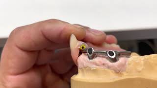 Implant over denture using bar and clip