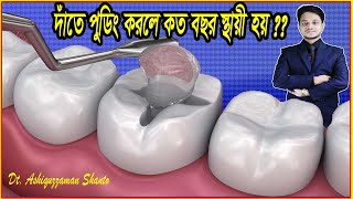 How long will the tooth filling last? / দাঁতের ফিলিং করার কত বছর স্থায়ী? / দাতের ফিলিং খরচ