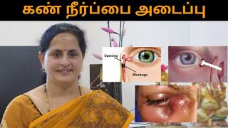 கண்ணீர் நீர் பை அடைப்பு #eyewatering #eyeinfection #block