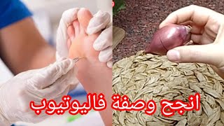 🔴وصفة علاج مسمار القدم في المنزل اليوم تتهناي من هذا المشكل بإذن الرحمن 🤲