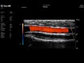 vevo md uhf 48 adult radial artery with colour flow