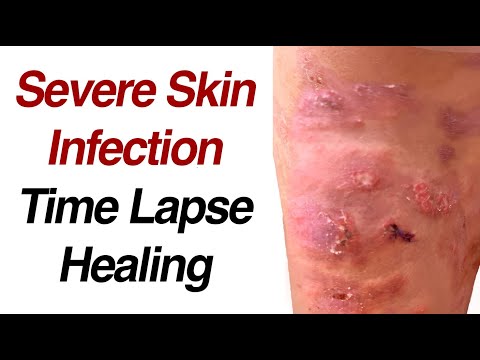 What does Staph look like on skin?