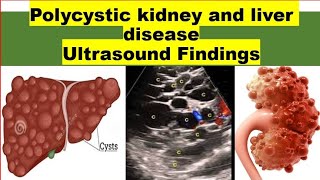 STOP Misdiagnosing Polycystic Kidney and Liver Disease with These Ultrasound Tips