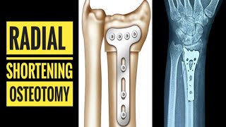 Radial Shortening Osteotomy for Kienbock's Disease