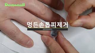 ■ 멍든손톱 피 제거 ■ 청담오라클피부과 (Subungual hematoma removal)