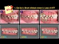 Treatment of CIII Malocclusion with invisalign｜【Chris Chang Ortho】CC669