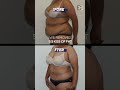 Abdominoplasty: Post-pregnancy with significant weight gain (Patient 3097)